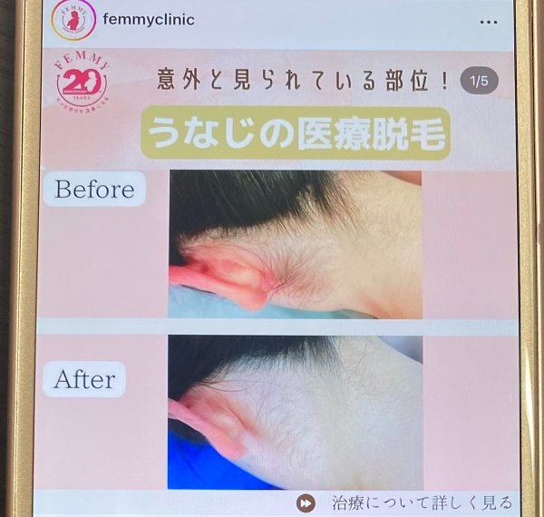 何回？自然に見える医療脱毛の回数は5〜8回